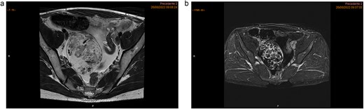Pelvic MRI highlighting a heterogeneous right ovarian lesion with high signal on axial T2 WI (a), and irregular enhanced septum on DCE T1 WI (arrow). Ascites and a pelvic nodule with fat and contrast enhancement (arrow head) (b).