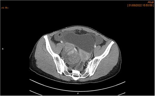 CT scan demonstrates a right ovarian mixed lesion measuring 80 × 67 × 57 mm, with solid, contrast-enhancing components, ascites, and prevesical fat stranding nodule, with no other categoric signs of carcinomatosis.