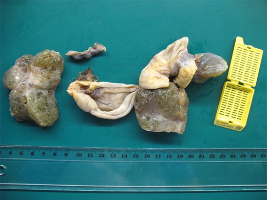 The thyroid tissue is the dominant component, along with a cyst with sebaceous material and hair.