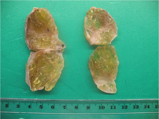 The sectioned surface is solid and cystic with a gelatinous, pale-yellow appearance (goiter-like).