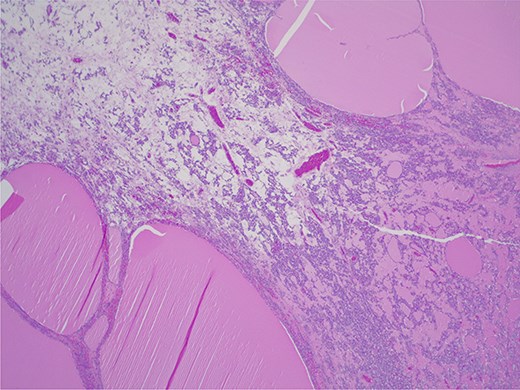 Struma ovarii—thyroid tissue is the dominant component with large and small colloid-containing follicles: H&E ×25.