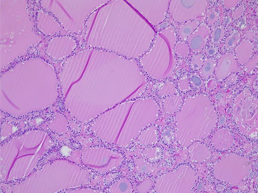 Struma ovarii—small and large thyroid follicles; H&E ×100.