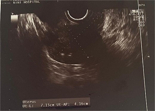 Transvaginal ultrasound showing the uterus.