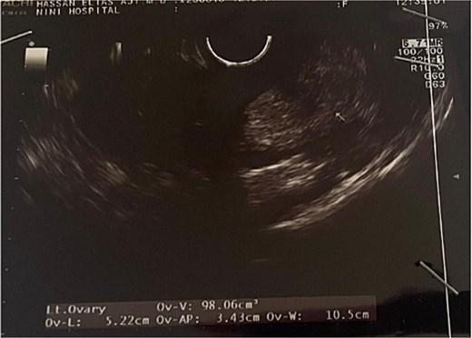 Transvaginal ultrasound showing the left ovary.
