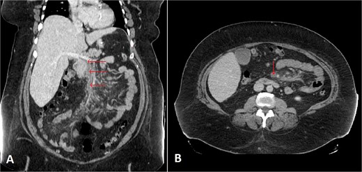 Selected coronal (A) and axial (B) cuts of the patient’s abdomen CT scan with IV contrast showing intra-luminal filling defect in the SMV, extending proximally to the proximal part of the main portal vein (arrows) associated with surrounding mesenteric fat haziness, representing portomesenteric venous thrombosis.