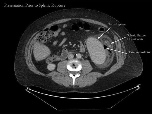 Computed tomography of the abdomen and pelvis on presentation showed acute diverticulitis of the splenic flexure with moderate wall thickening and adjacent extraluminal gas consistent with localized perforation.