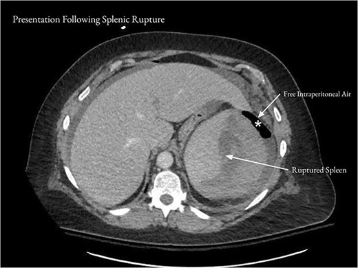After the patient represented with acute worsening of abdominal pain, CT of the abdomen and pelvis showed a 7.2 cm subcapsular hematoma of the spleen (arrows) and moderate free intraperitoneal air (asterisk).
