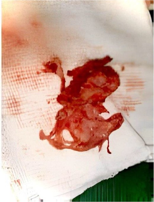 Capillary hemangioma of the maxillary sinus after excision.
