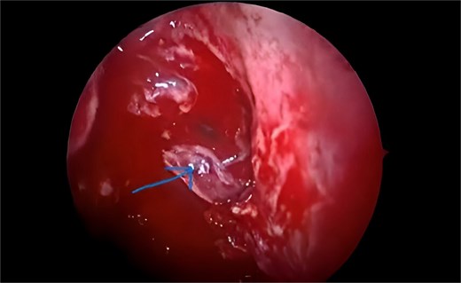 A biopsy was performed on the mass, which is composed of two pieces of tan-colored tissue. The histopathological analysis reveals blood vessels of varying sizes, separated by fibrous septa. These vessels are lined with plump endothelial cells, and a few of them are filled with blood.
