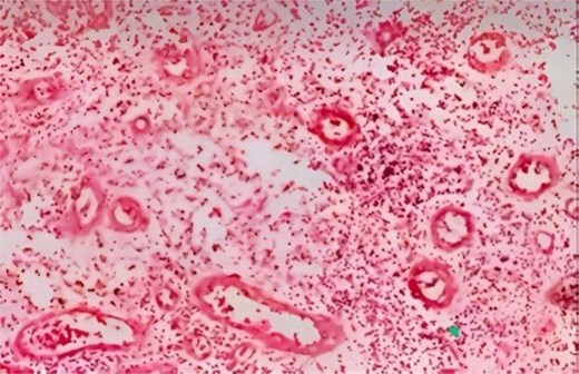 Maxillary sinus endoscopy showing hemangioma of the maxillary sinus.