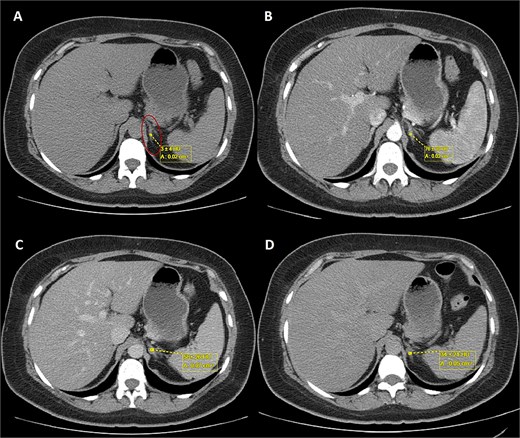 Triphasic abdominal CT scan with left adrenal adenoma (ellipse). (A) Simple phase, (B) arterial phase, (C) venous phase, (D) late venous phase.