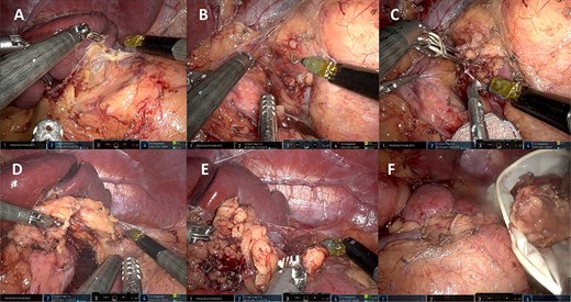 Left robotic adrenalectomy. (A, B) Left adrenal exposure, (C) control of the main adrenal vein, (D) gland dissection, (E) completion of the dissection, (F) end of the operation.