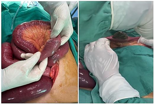 The meat bezoar is seen completely obstructing the small bowel lumen.