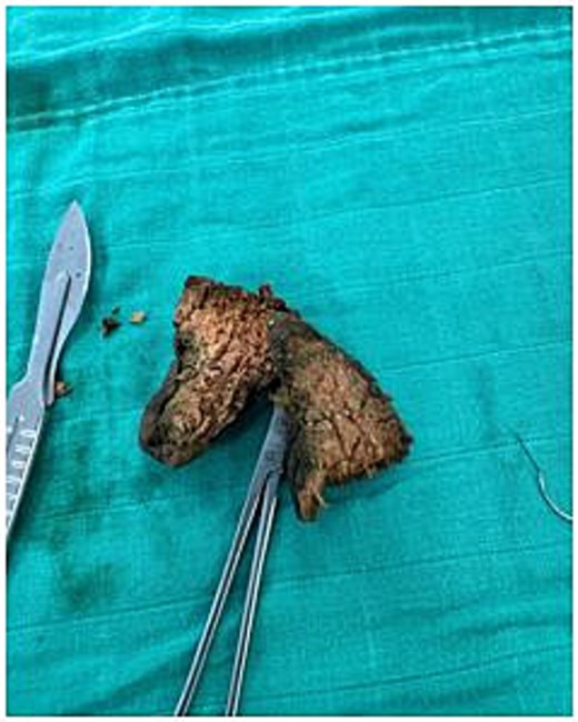 The meat bezoar, composed of cooked and undigested food (identified as liver parenchyma), is removed from inside of the small bowel.