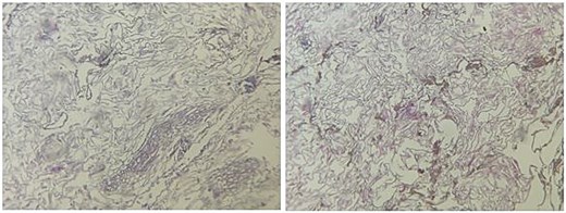 Histopathological alterations of liver parenchyma: microscopic study.