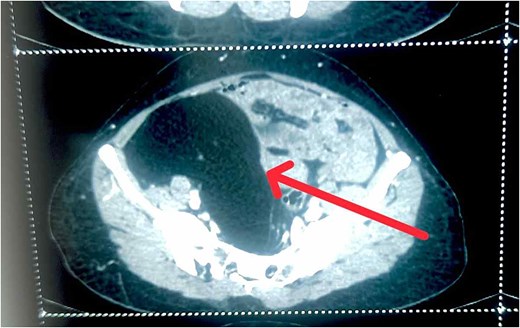 CECT abdomen showing well-defined hypodense abdominopelvis lesion of fat density in right side.