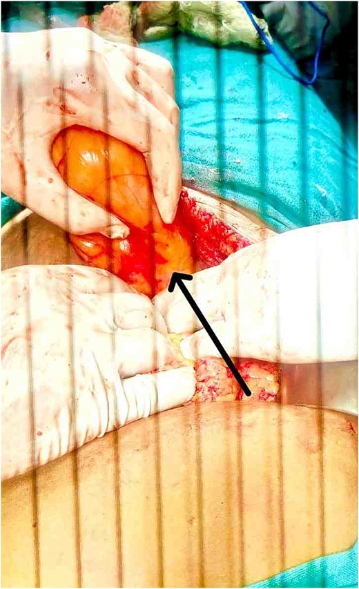 Intraoperative finding showed well-encapsulated mass ~15 × 12 cm in right iliac fossa.