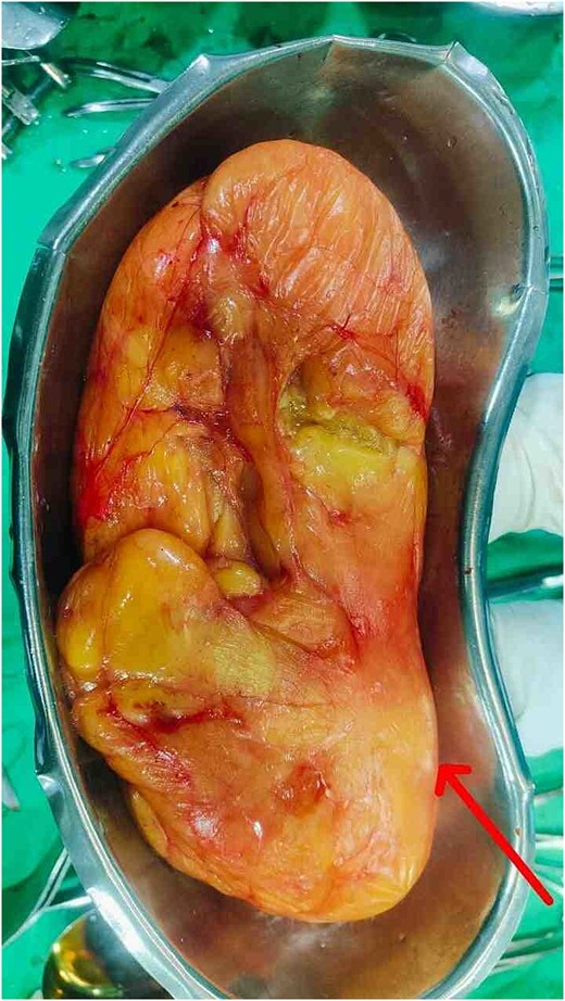 Gross surgical specimen showing, firm fatty mass was 15 × 12 cm weighs ~2077 kg.