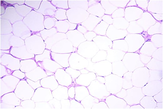 Histopathology revealed well-defined capsulated and lobulated lesion of mature fat uniform in size with intervene fibrous septa with small arborizing vessel most likely lipoma.
