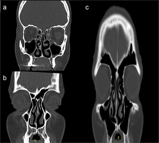 Computed tomography scans showing unilateral nasal obstruction caused by septal spurs, corresponding to Mladina type 5 (lateral nasal wall contact) and type 6 (bilateral spurs) nasal septum deviations.