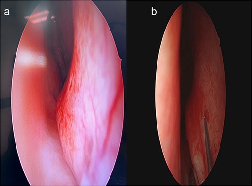 Intraoperative endoscopic view of the deviated nasal septum prior to correction.