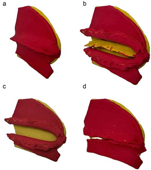 Stepwise illustration of the INES technique. (a) Deviated segment identification; (b) limited mucosal incision and flap elevation; (c) targeted resection of deviated cartilage; (d) mucosal closure without using Silastic sheets/suturing.