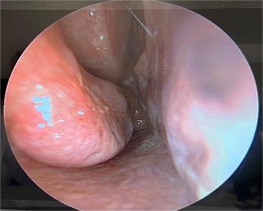 Six-month postoperative follow-up endoscopic view demonstrating healed mucosa and patent nasal airway.