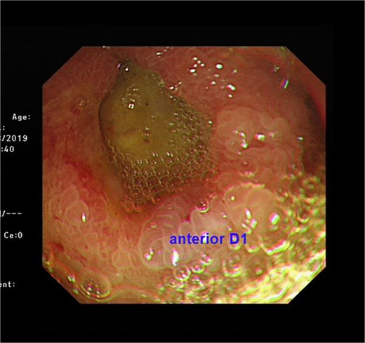 Endoscopic view showing a chronic duodenal ulcer.