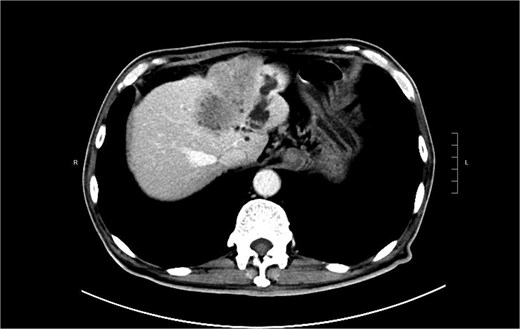 CT showing showing an exophytic hypoenhancing mass at left liver with dilated left intrahepatic duct.