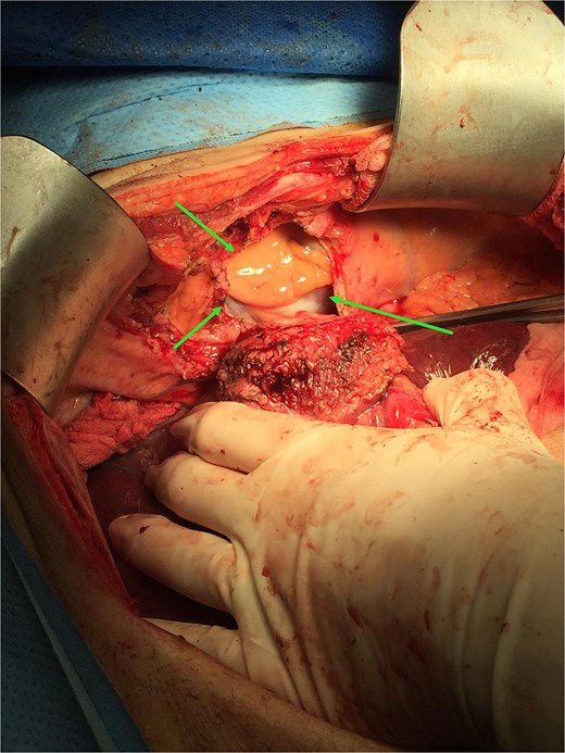 Operative photo showing the pericardium was removed en bloc with liver tumor, the heart was exposed (arrows).