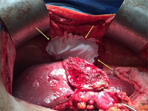 The diaphragm and pericardium was closed with Gore-Tex mesh (arrows).