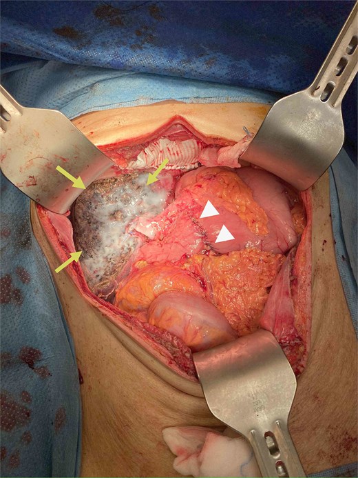 Specimen removed, the transected liver surface was covered with applied tissue glue (arrows) and the duodenal repair site was seen (arrow heads).
