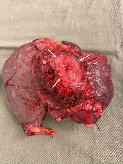 Specimen showing removed liver with attached pericardium (arrows).