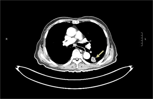 CT revealed a left lower lobe lung lesion (arrow).