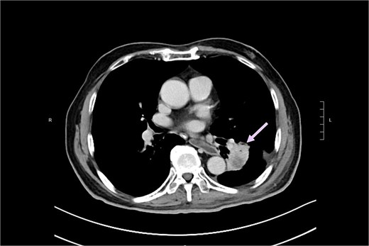 CT revealed post-radiation change in lung lesion (arrow).