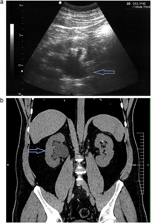 (a) Abdominal ultrasound demonstrating right kidney with evidence of grade 2–3 hydronephrosis. (b) Right kidney right-sided ureterohydronephrosis on CT scan.