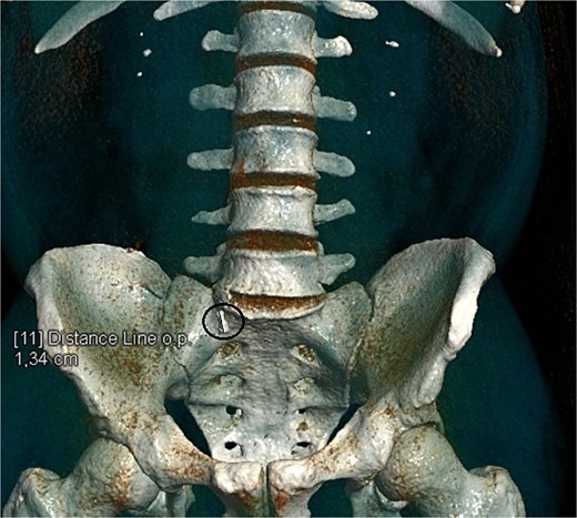 CT scan reconstruction—cluster of stones sizes, respectively, 5.2 mm, 3.2 mm, 2.8 mm—13.4 mm combined in the right distal ureter.