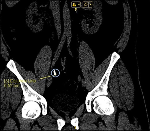 CT scan of steinstrasse formed in the right distal ureter.