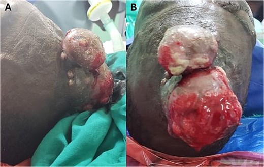 (A) Bicornuate, ulcerated forehead mass with irregular borders. (B) The mass was friable with areas of bleeding and sloughing.