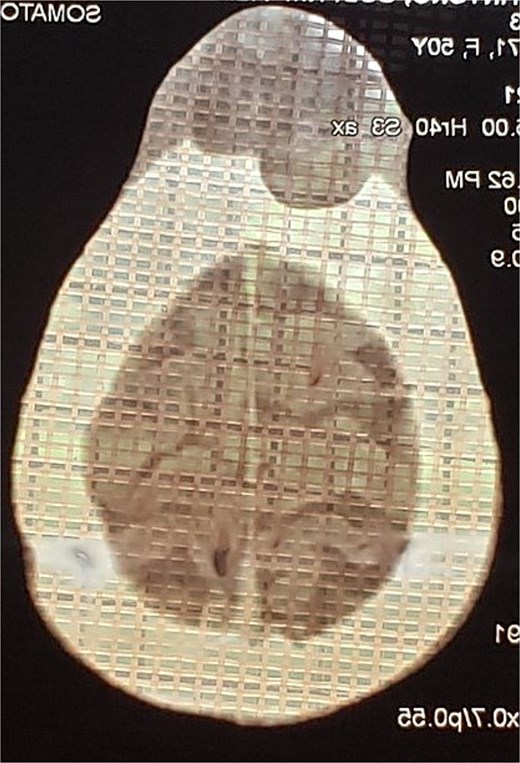 CT scan of the head demonstrating a frontal forehead mass with extension to the underlying skull.