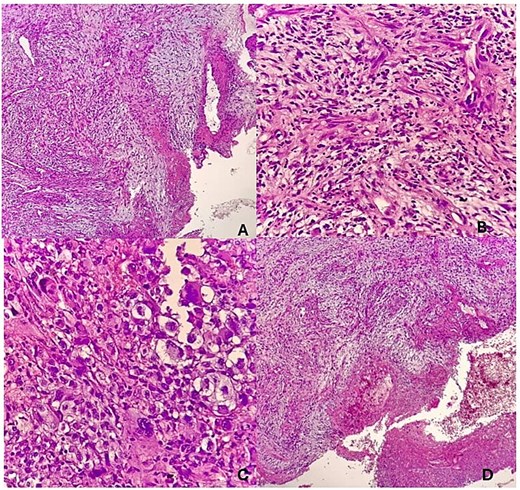 (A) Sections show tissue with an ulcerated squamous cell epithelium, having a false membrane and an acute on chronic inflammatory cellular infiltrate. (B) The stroma has a fibromyxoid component with aypical spindle and fat cells. (C) The cells are pleomorphic with prominent nucleoli. (D) There is increased vascularization.