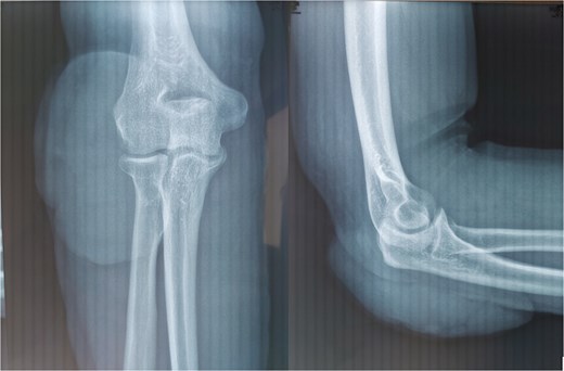 Front and side X-rays of the elbow.