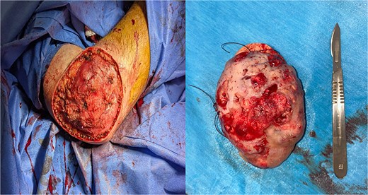 Surgical removal of pilomatricoma under general anesthesia.
