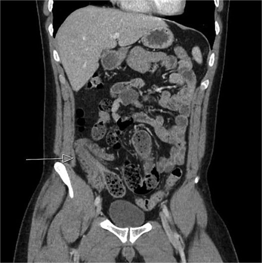 Initial CT imaging, axial cut, showed an abnormal ileocolic configuration with intussusception of the distal ileal loop through the cecum.