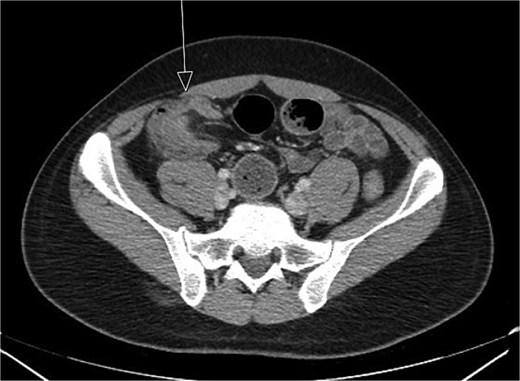 Initial CT imaging, coronal cut, showed an abnormal ileocolic configuration with intussusception of the distal ileal loop through the cecum.
