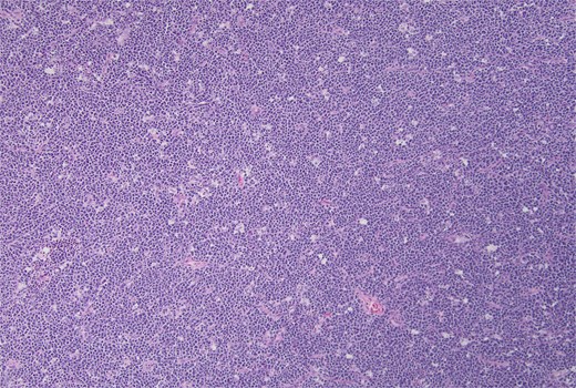 Hematoxylin and eosin stain, starry sky pattern showing a dense infiltrate by Burkitt lymphoma with numerous tingible body macrophages. 10× magnification.