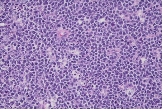 Hematoxylin and eosin stain, high-power view showing a monotonous population of uniform medium-sized lymphocytes and background tingible body macrophages. 40× magnification.