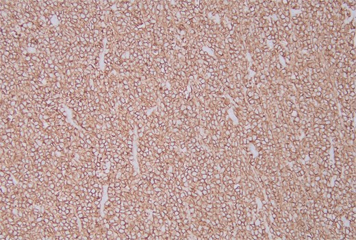 The immunohistochemical stain for CD20 is positive.