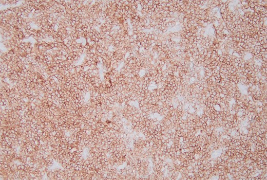 The immunohistochemical stain for CD10 is positive.