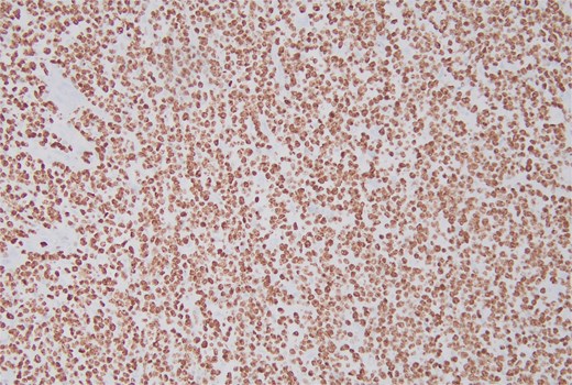 The immunohistochemical stain for Ki-67 is positive.